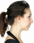 A profile view of a patient after jaw surgery