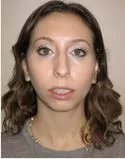 A front view of a patient before jaw surgery