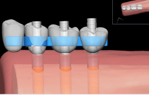 An illustration of placed implants with crowns attached
