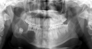 Panoramic x-ray of a patients tumor, causing 3rd molar to be misplaced and dissipation of molar roots.