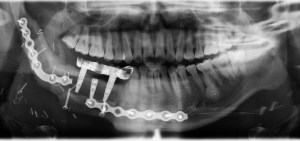 Post operative x-ray of implants