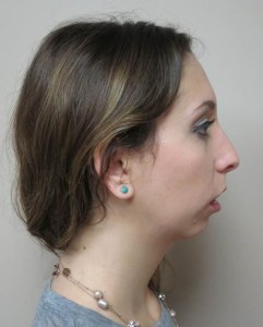Profile view of patient before jaw surgery