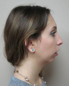 Profile view of patient before jaw surgery