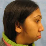 Before Jaw Surgery, side view