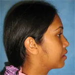 After Jaw Surgery, side view
