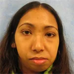Before Orthognathic surgery, front view