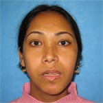 After Orthognathic surgery, front view