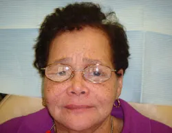 Patient with oral cancer prior to treatment