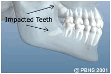 Diagram of impacted wisdom teeth