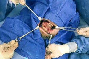Oral Surgery Procedure